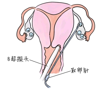 小儿退烧推拿手法 5种长春捐卵宝宝退烧按摩方法